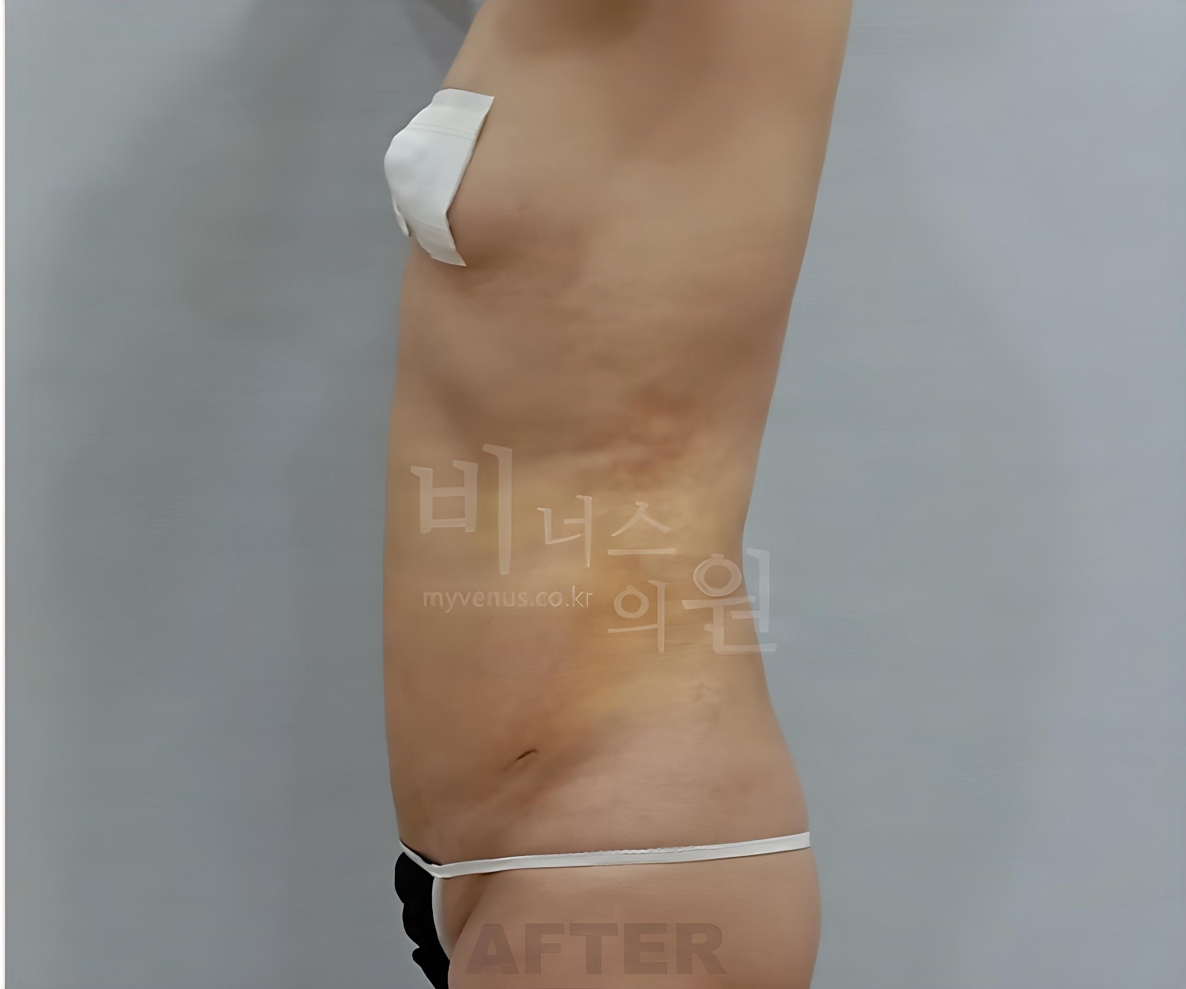 복부 지방흡입 수술 후 측면