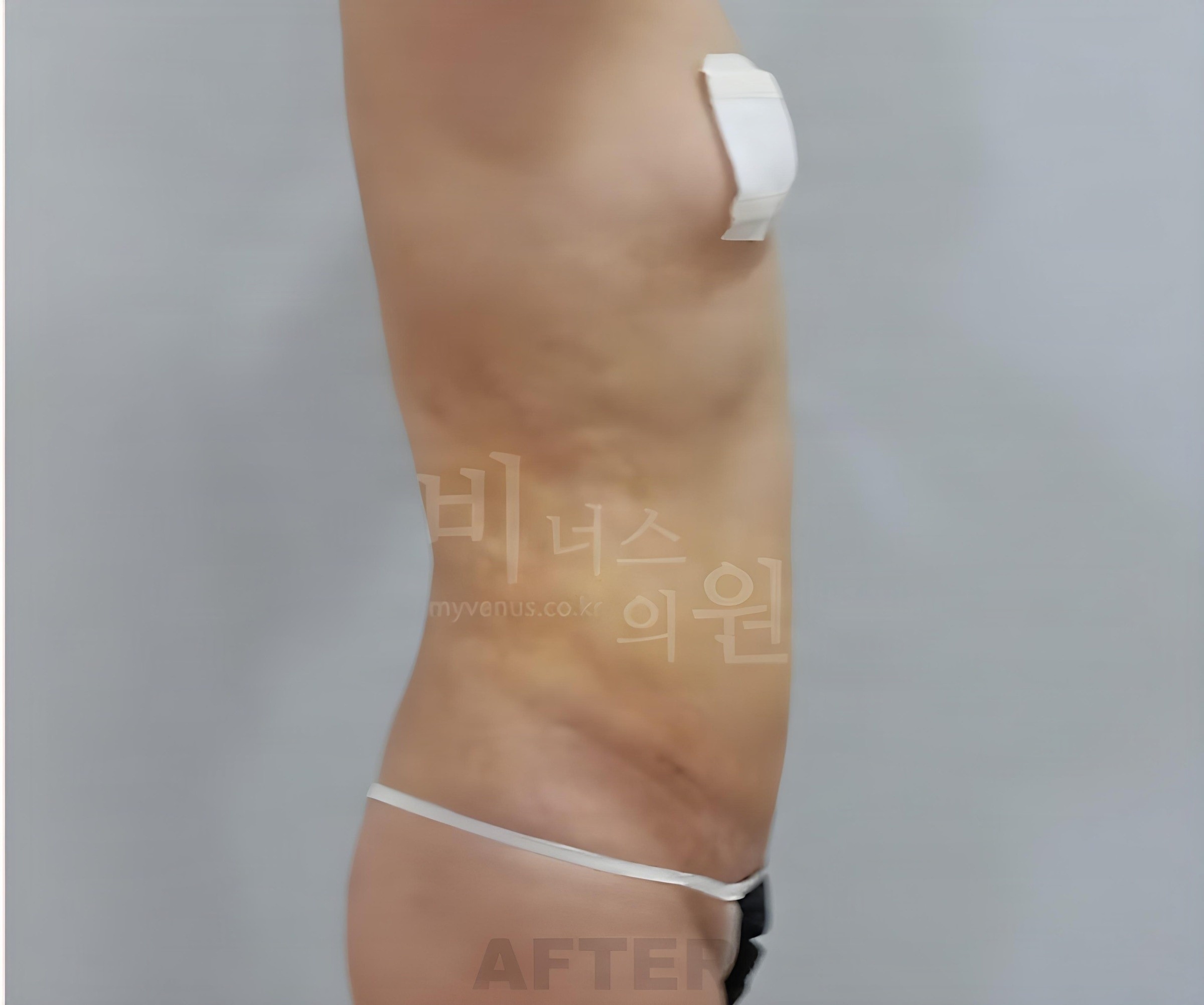 복부 지방흡입 수술 후 측면(우)