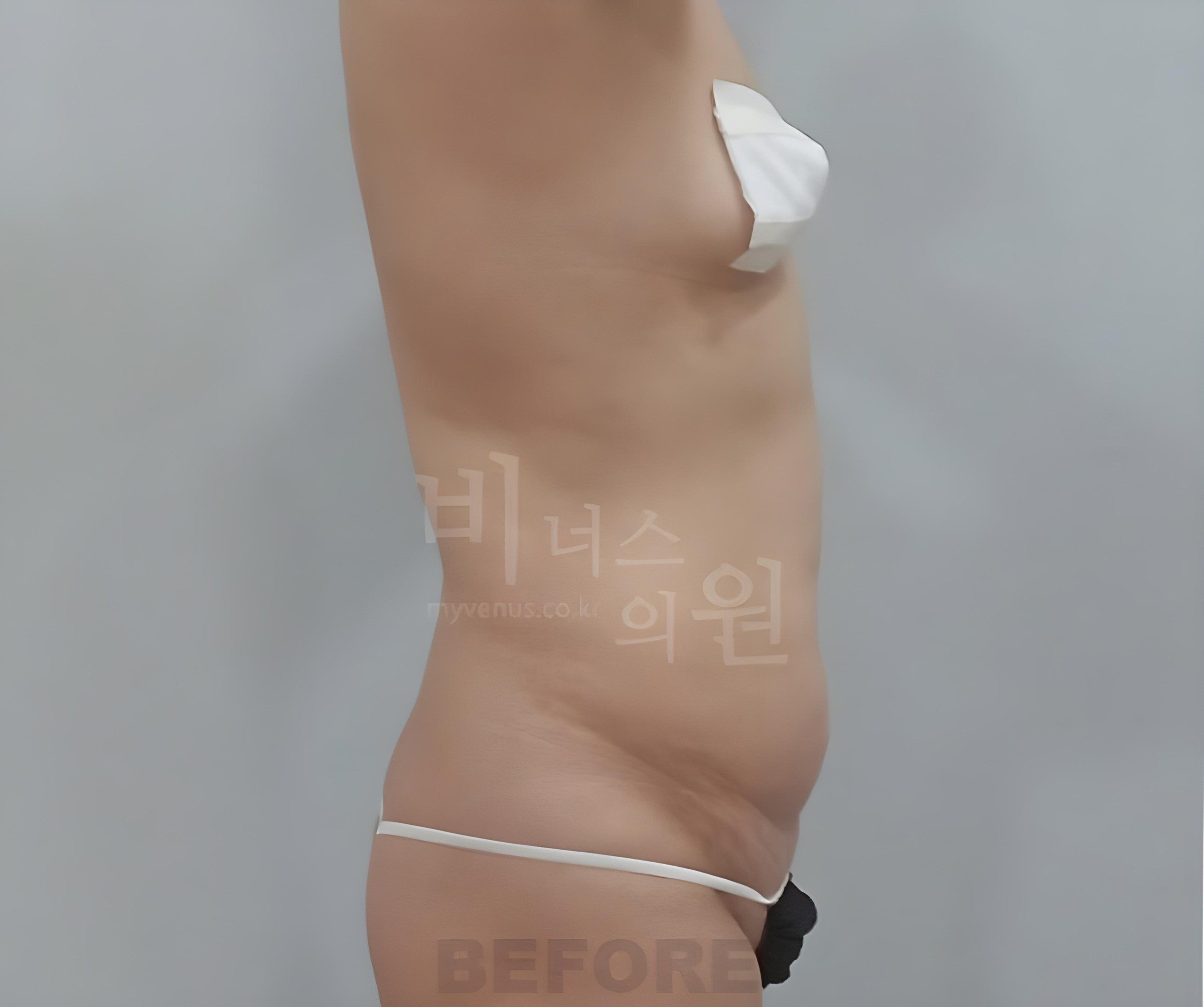 복부 지방흡입 수술 전 측면(우)