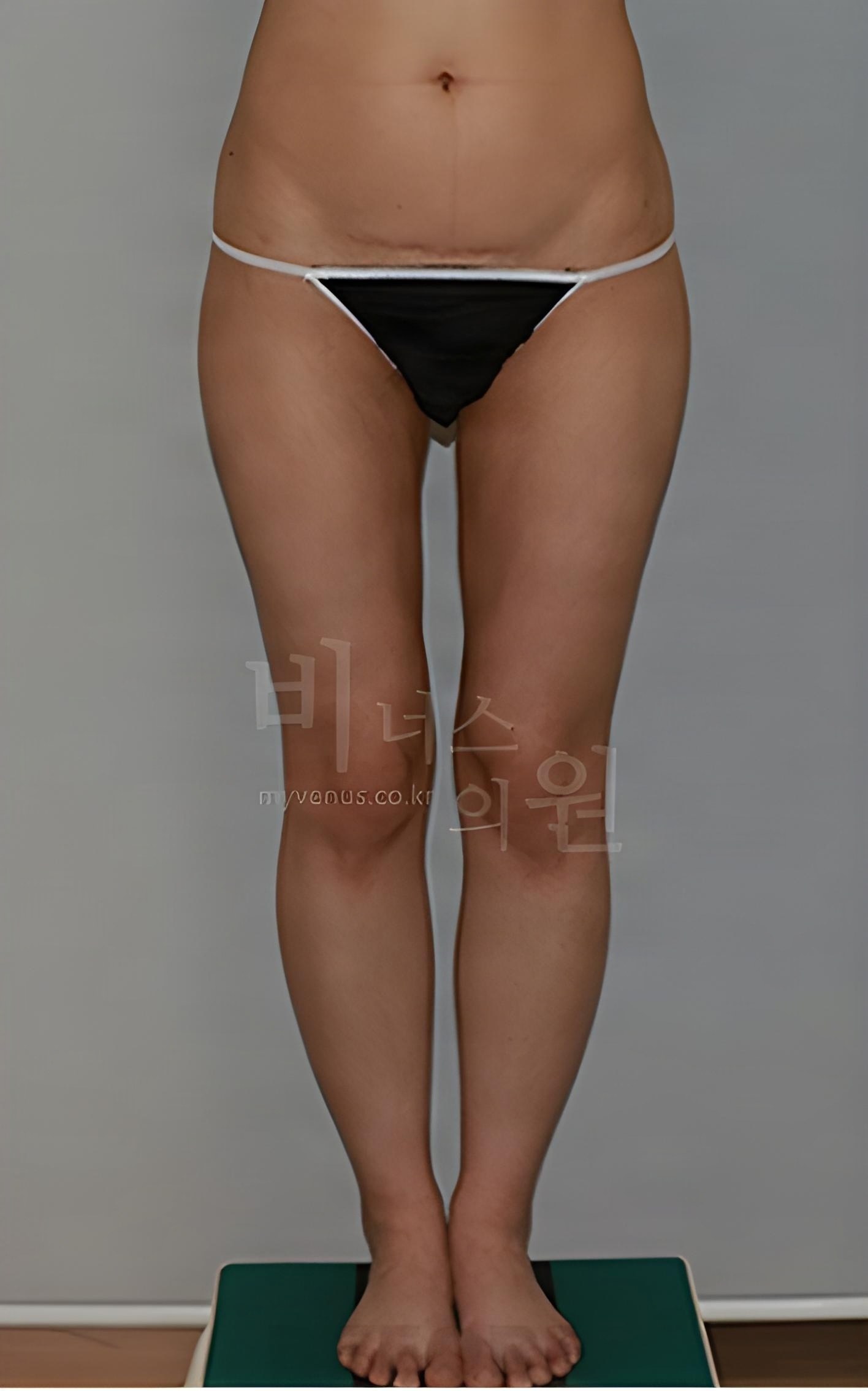 엉덩이 지방흡입 수술 전 정면 사진, 골반 바깥선과 허벅지 상부