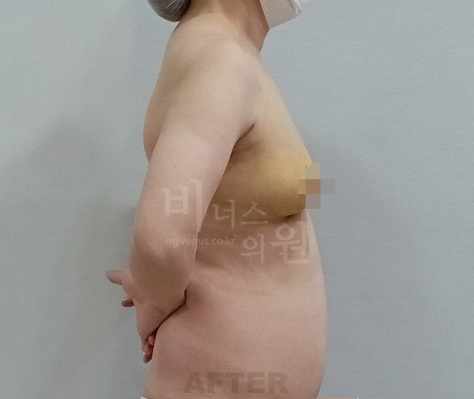 가슴 전후사진 수술 후 측면 — 팔을 앞으로 모은 자세