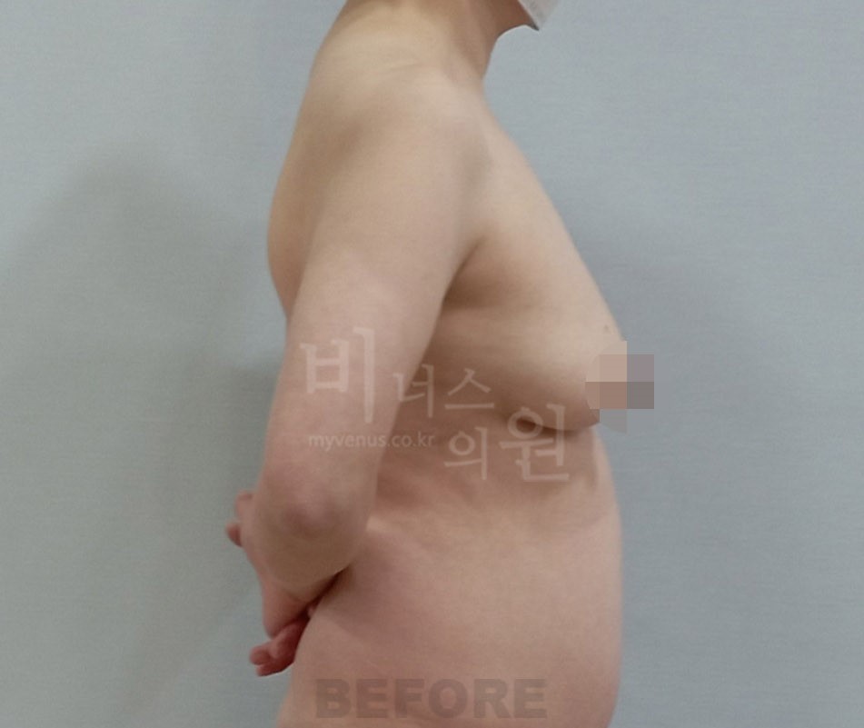 가슴 전후사진 수술 전 측면 — 팔을 앞으로 모은 자세