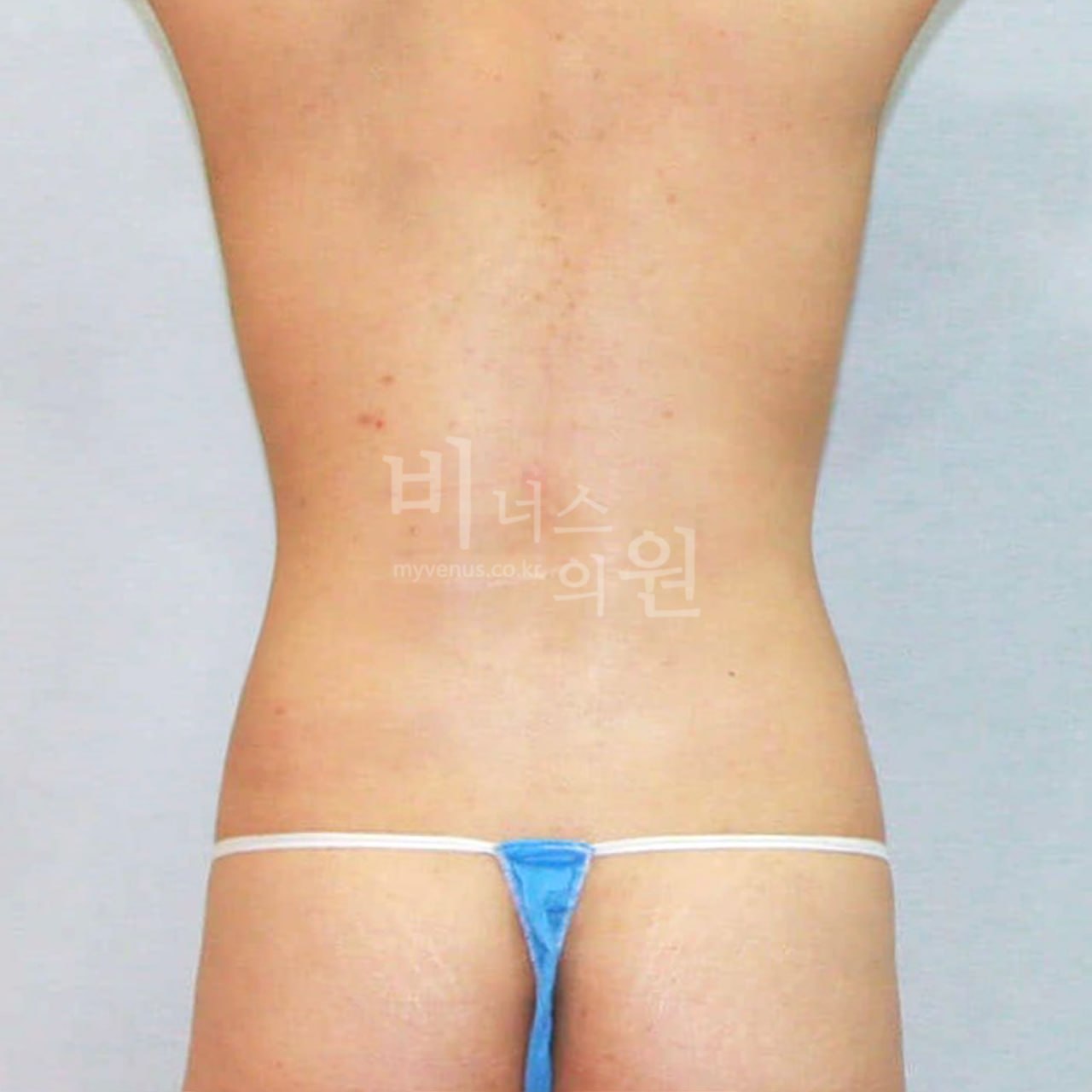 복부지방흡입 후 — 후면
