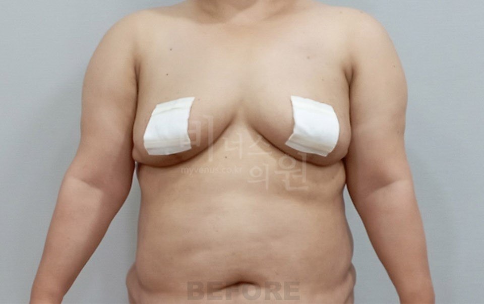 팔뚝 지방흡입 수술 전후 1 수술 전