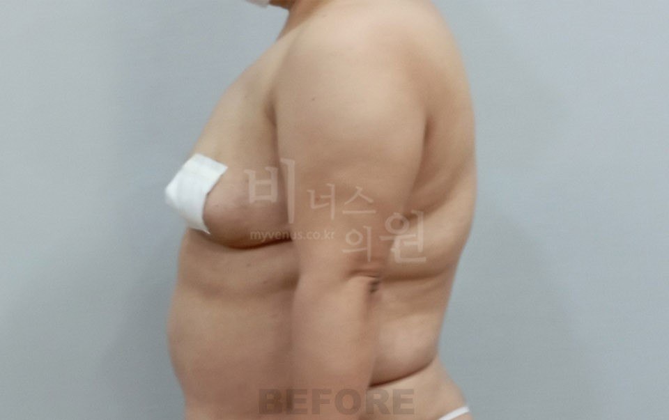팔뚝 지방흡입 수술 전후 2 수술 전
