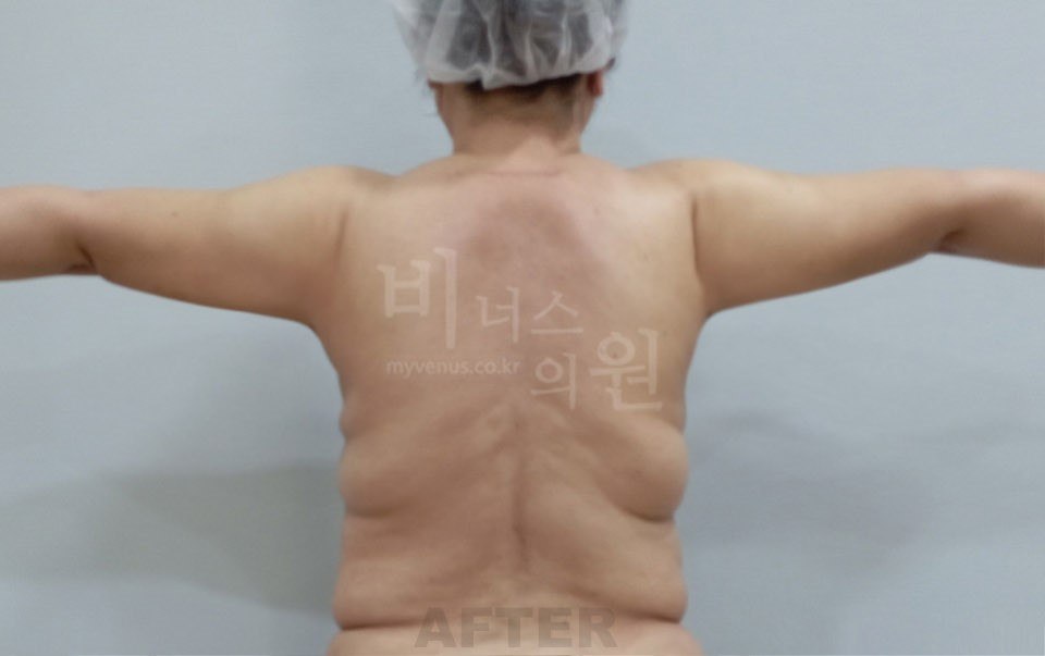 팔뚝 지방흡입 수술 전후 3 수술 후
