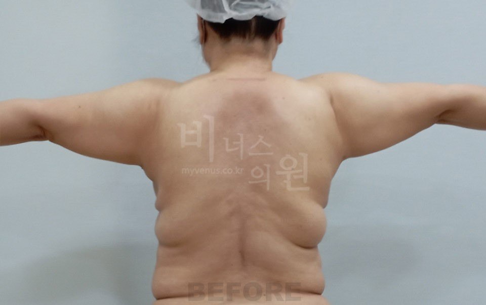 팔뚝 지방흡입 수술 전후 3 수술 전