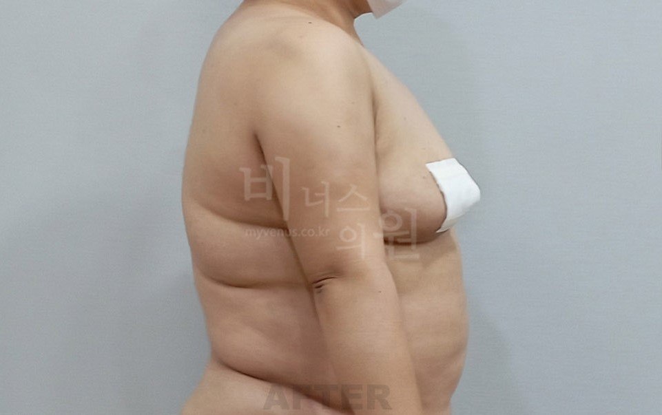 팔뚝 지방흡입 수술 전후 4 수술 후