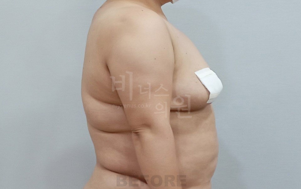 팔뚝 지방흡입 수술 전후 4 수술 전