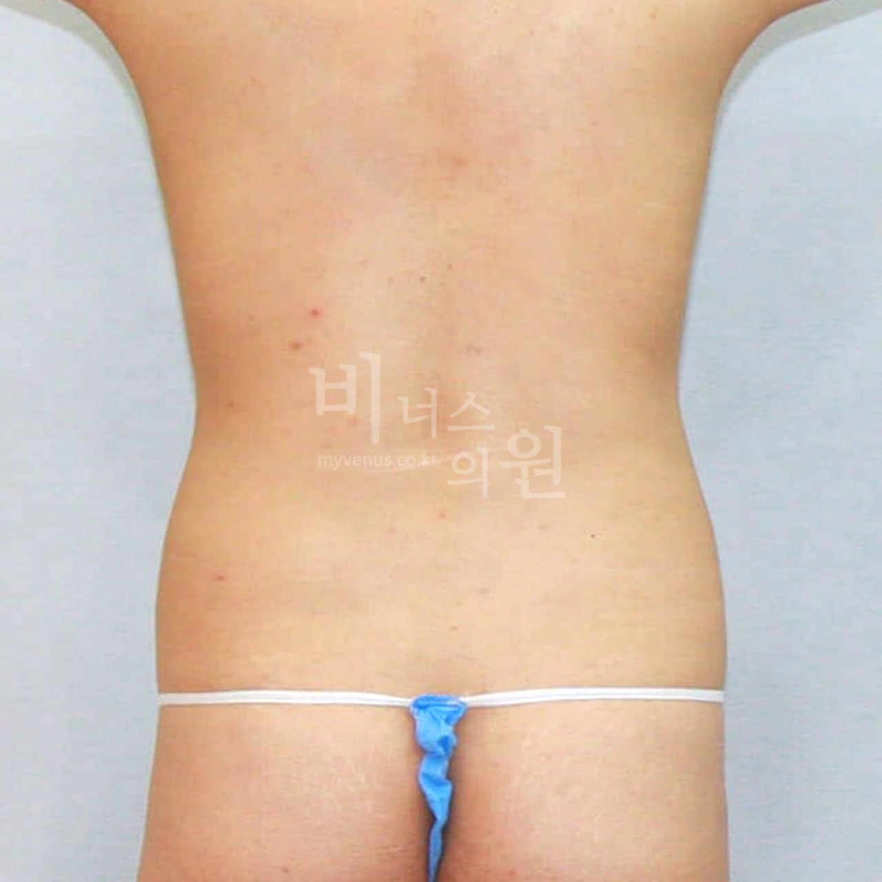 복부지방흡입 전 — 후면