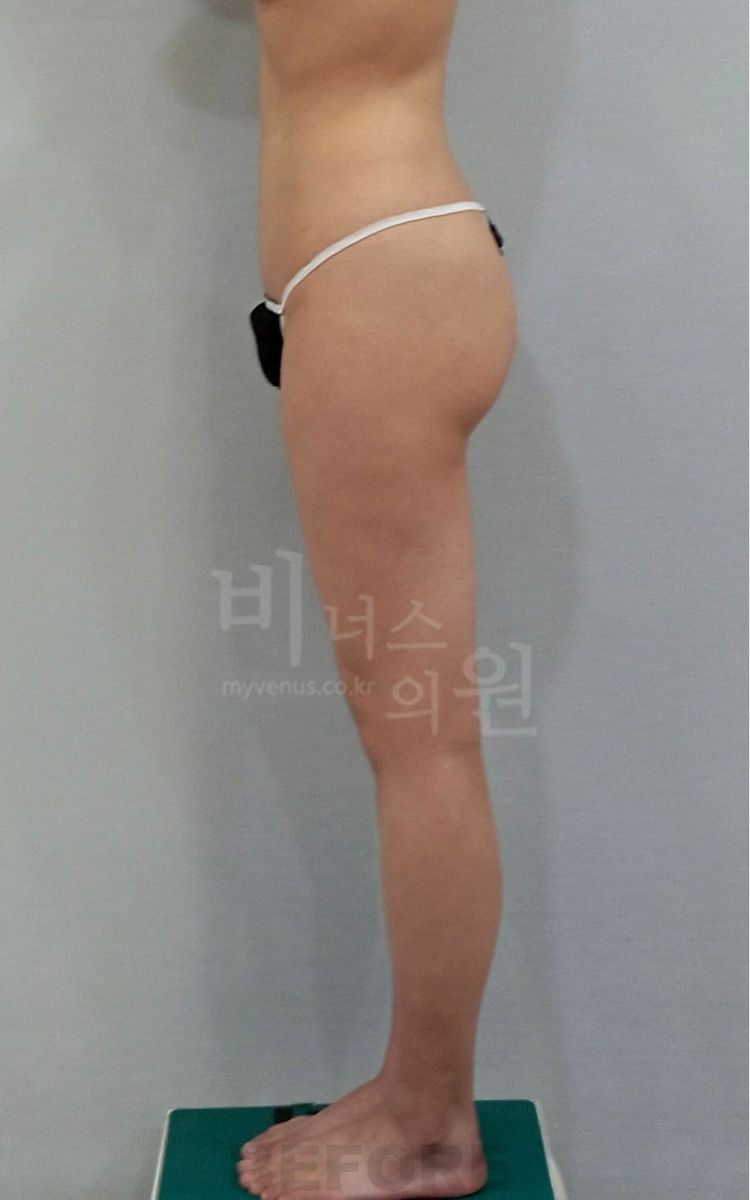 엉덩이축소 허벅지지방흡입 수술 전 측면