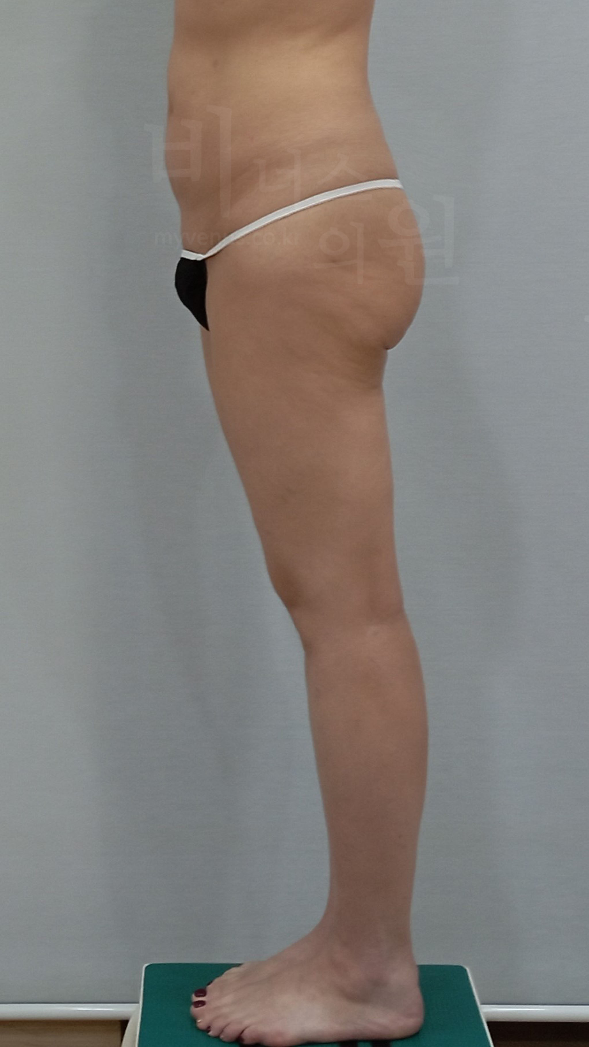 엉덩이지방흡입 수술 전 측면