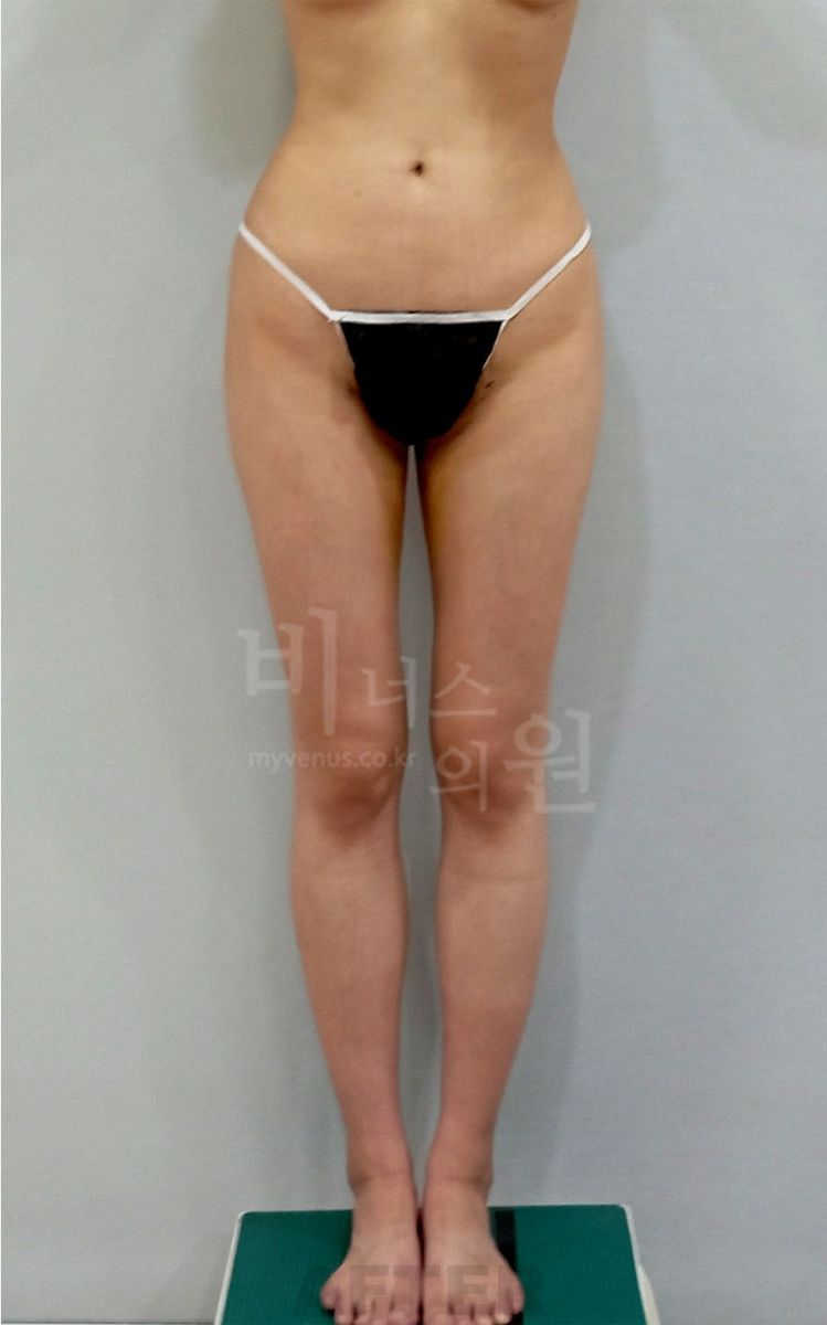 엉덩이축소 허벅지지방흡입 수술 후 정면