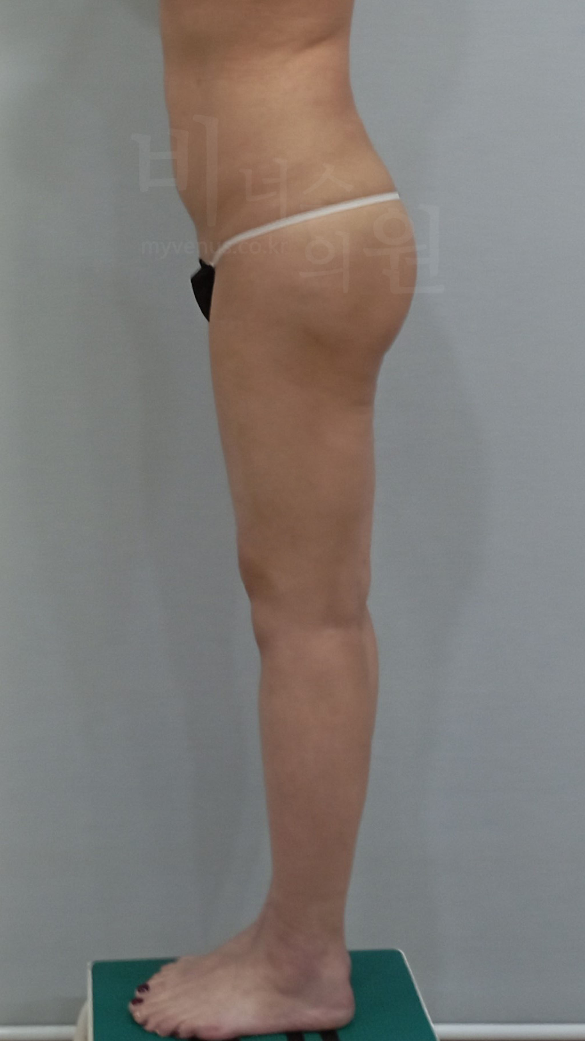 엉덩이지방흡입 수술 후 측면 — 힙라인 상승