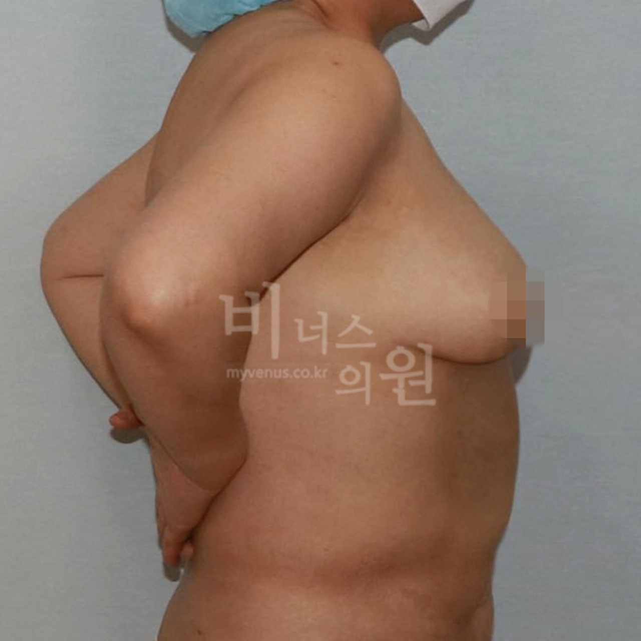 가슴축소 지방흡입 수술 후 왼측 비너스의원