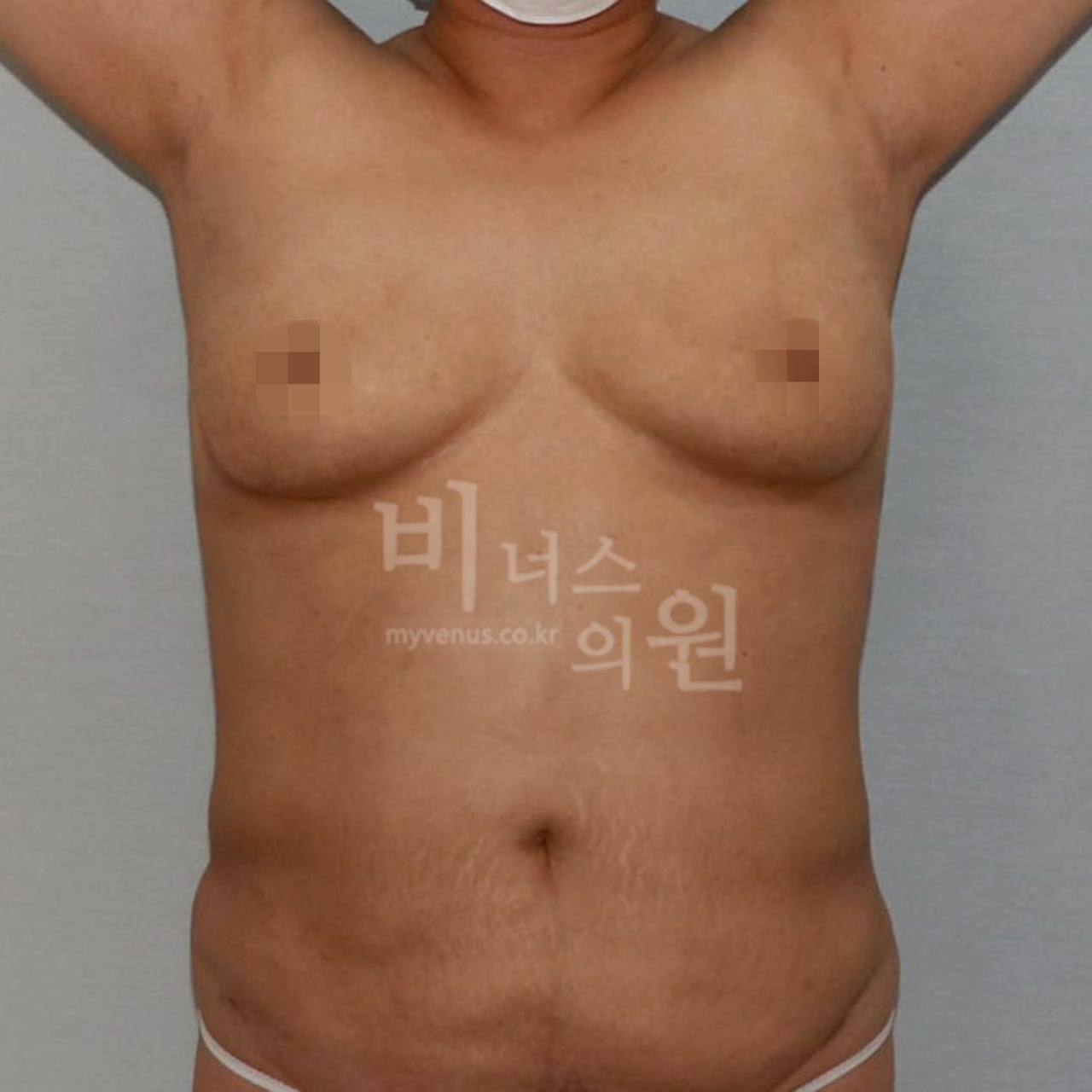 가슴축소 지방흡입 수술 후 정면 비너스의원