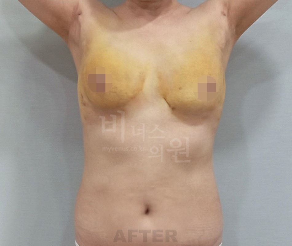 유방처짐 가슴축소 지방흡입 수술 후 정면