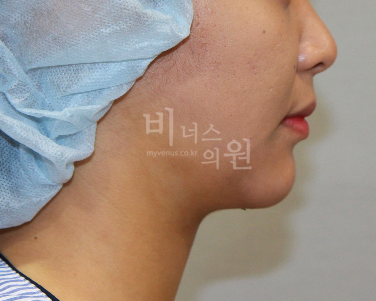이중턱 지방흡입 수술 후 3일 하악 라인 — 부천 비너스의원