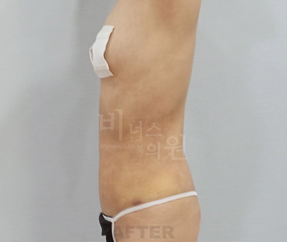 복부 지방흡입 수술 후 측면 비너스의원