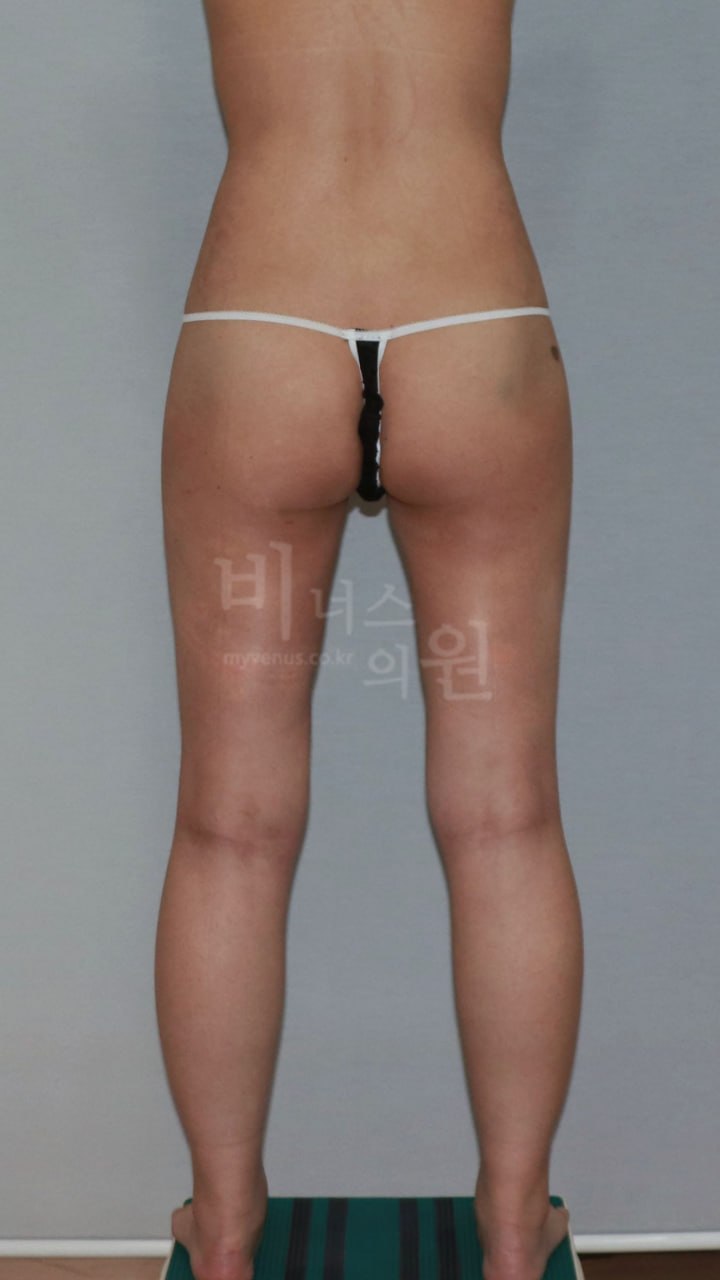 엉덩이지방흡입 수술 후 비너스의원