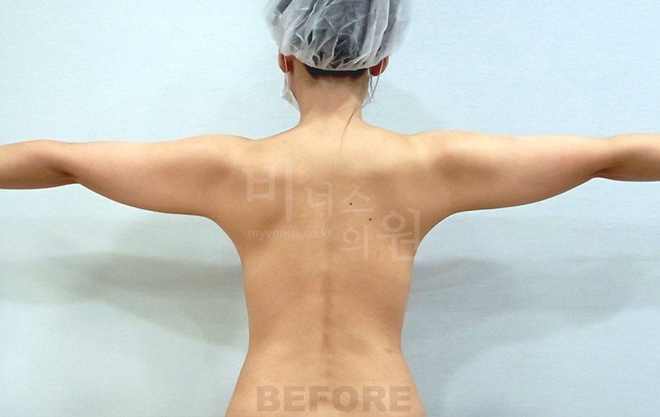 팔뚝 지방흡입 수술 전 비너스의원
