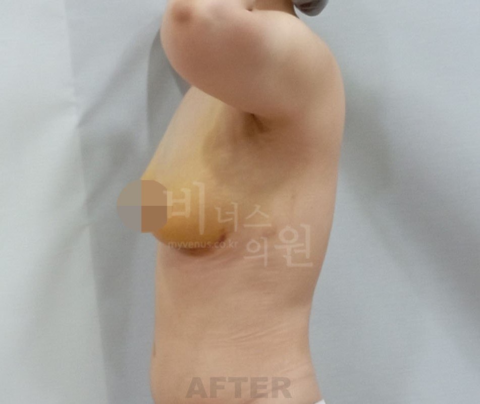 가슴축소 지방흡입 수술 후 측면 비너스의원