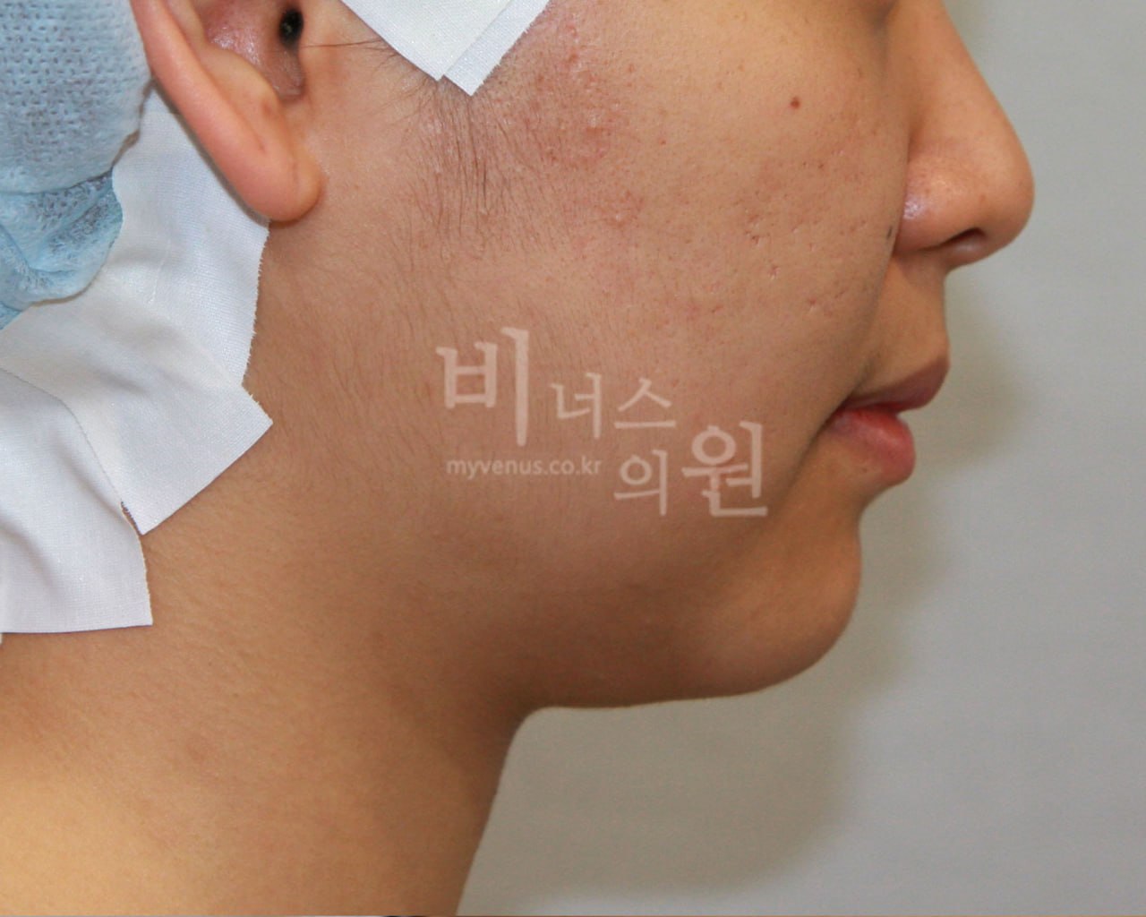 이중턱 지방흡입 수술 전 하악 라인 — 부천 비너스의원