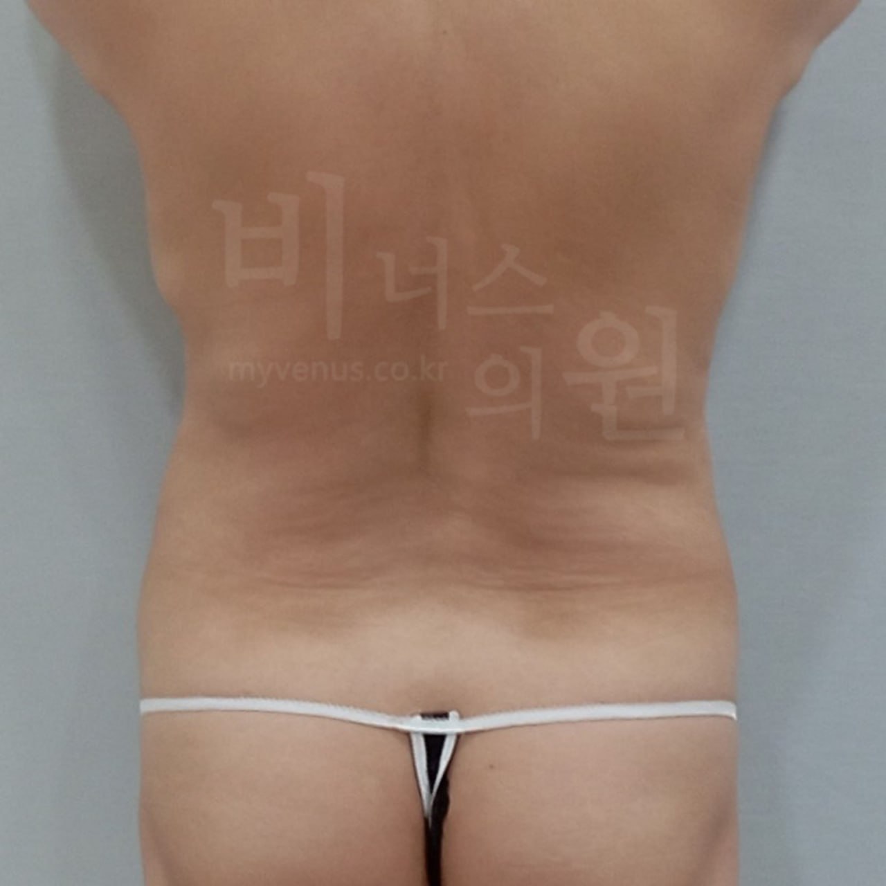 복부 지방흡입 수술 전 사례 3 비너스의원
