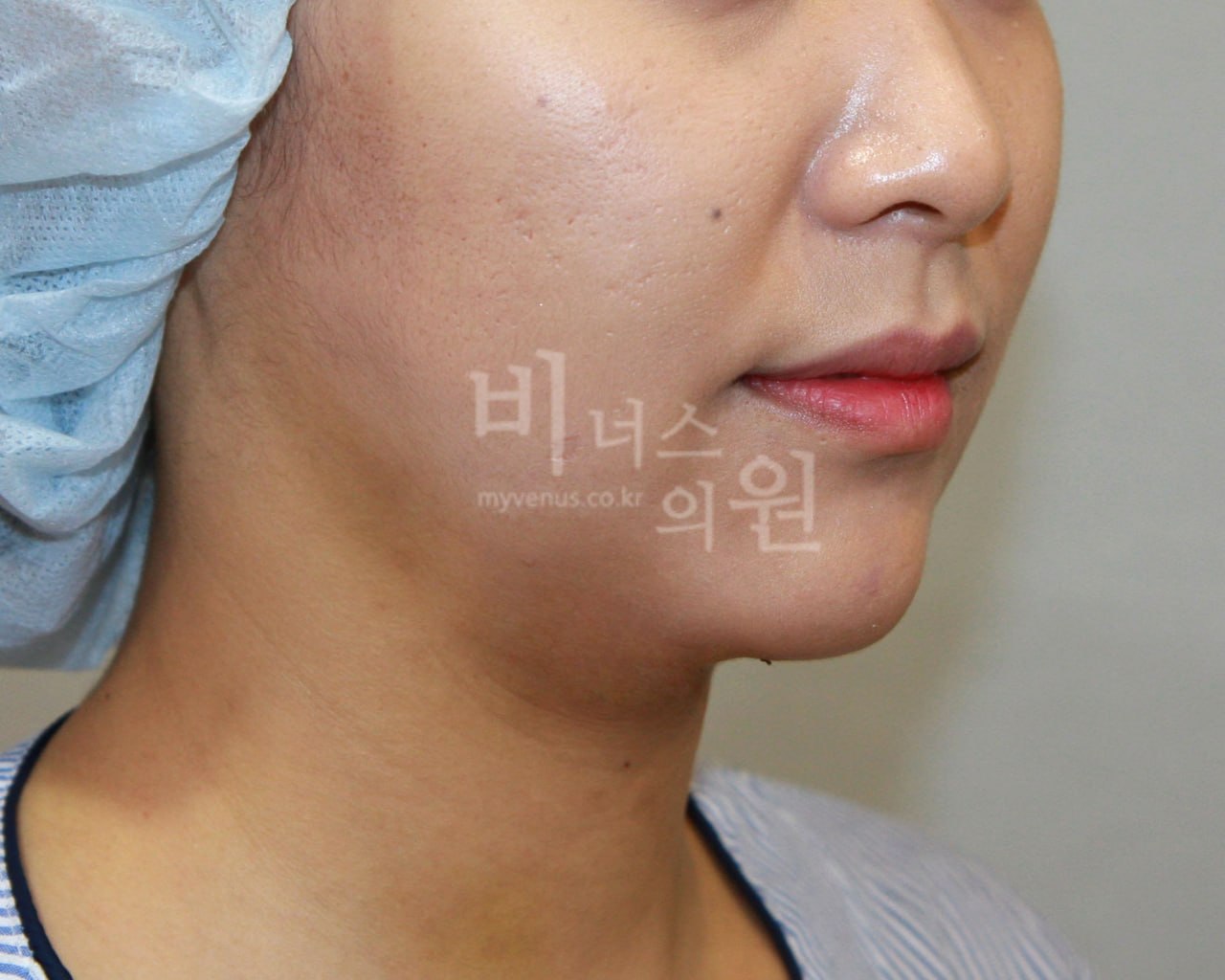 이중턱 지방흡입 수술 후 3일 우측면 목라인 — 부천 비너스의원