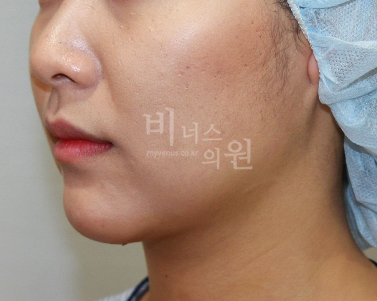 이중턱+턱라인 지방흡입 수술 후 3일 정면 — 부천 비너스의원
