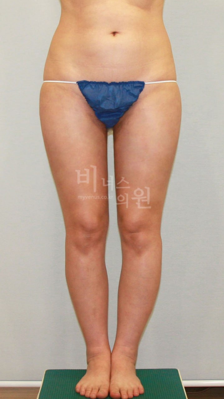 허벅지 지방흡입 수술 후 사례1