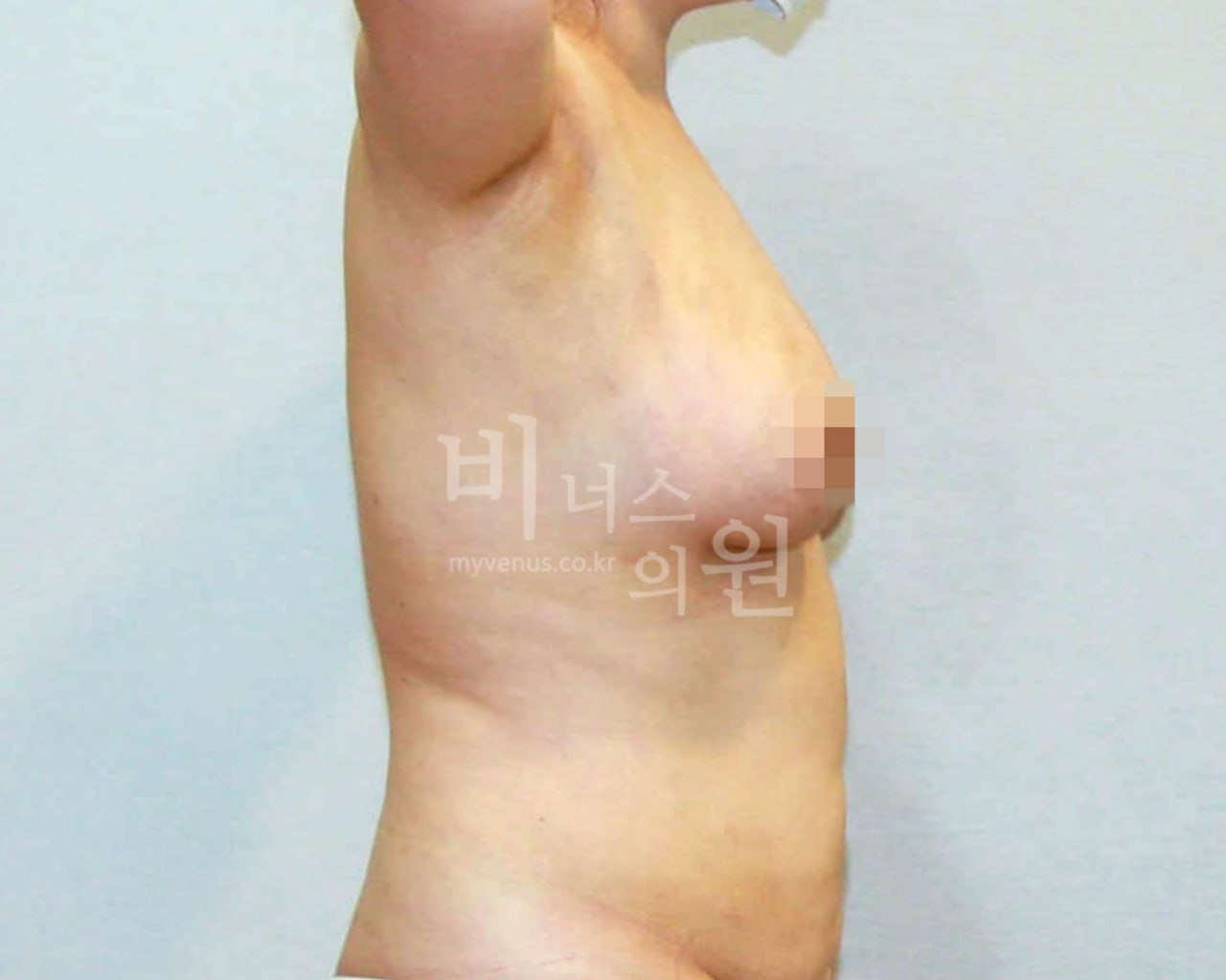 가슴축소 지방흡입 수술 후 사례 3 비너스의원