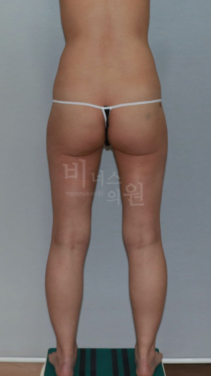 엉덩이지방흡입 수술 전 비너스의원