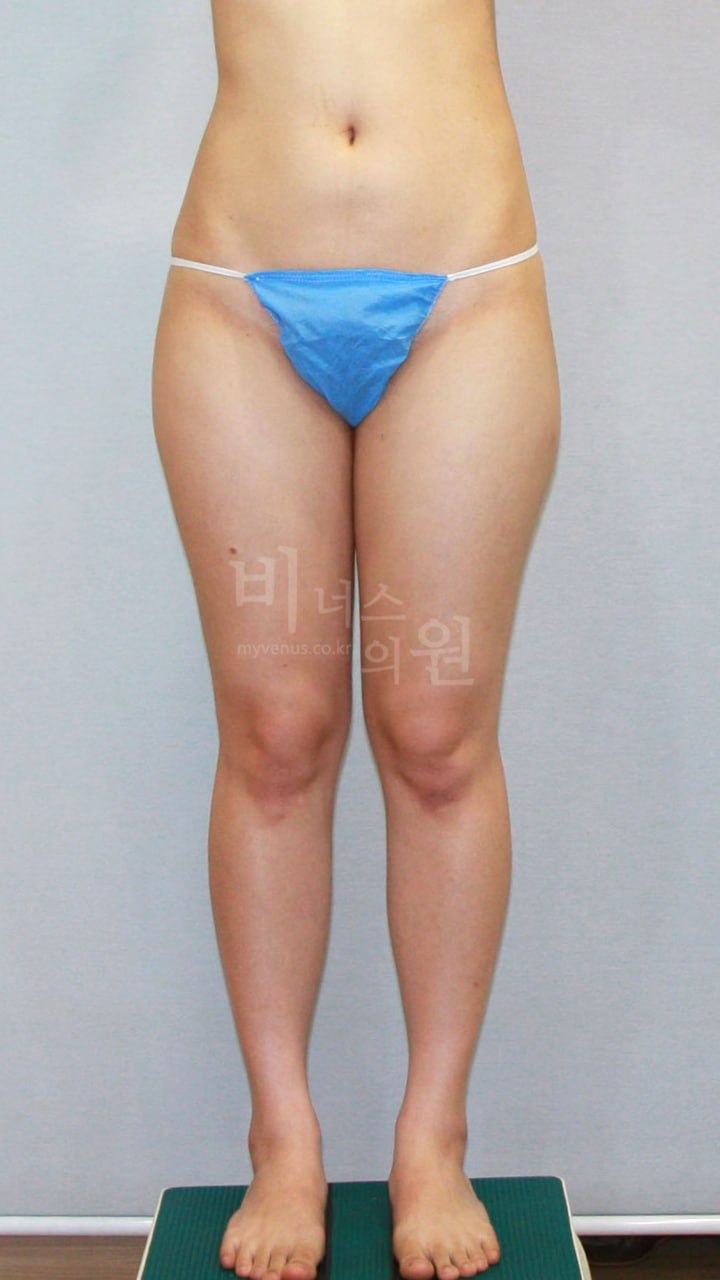 허벅지 지방흡입 수술 전 사례 1 비너스의원