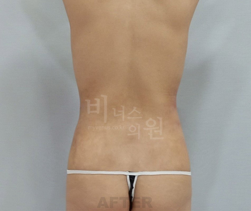 복부 지방흡입 수술 후 후면 비너스의원
