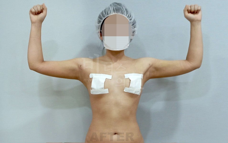 팔뚝 지방흡입 수술 후 비너스의원