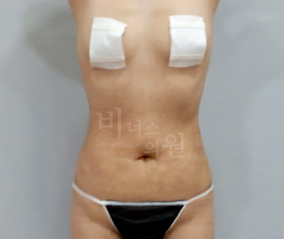 복부 지방흡입 수술 후 정면 비너스의원