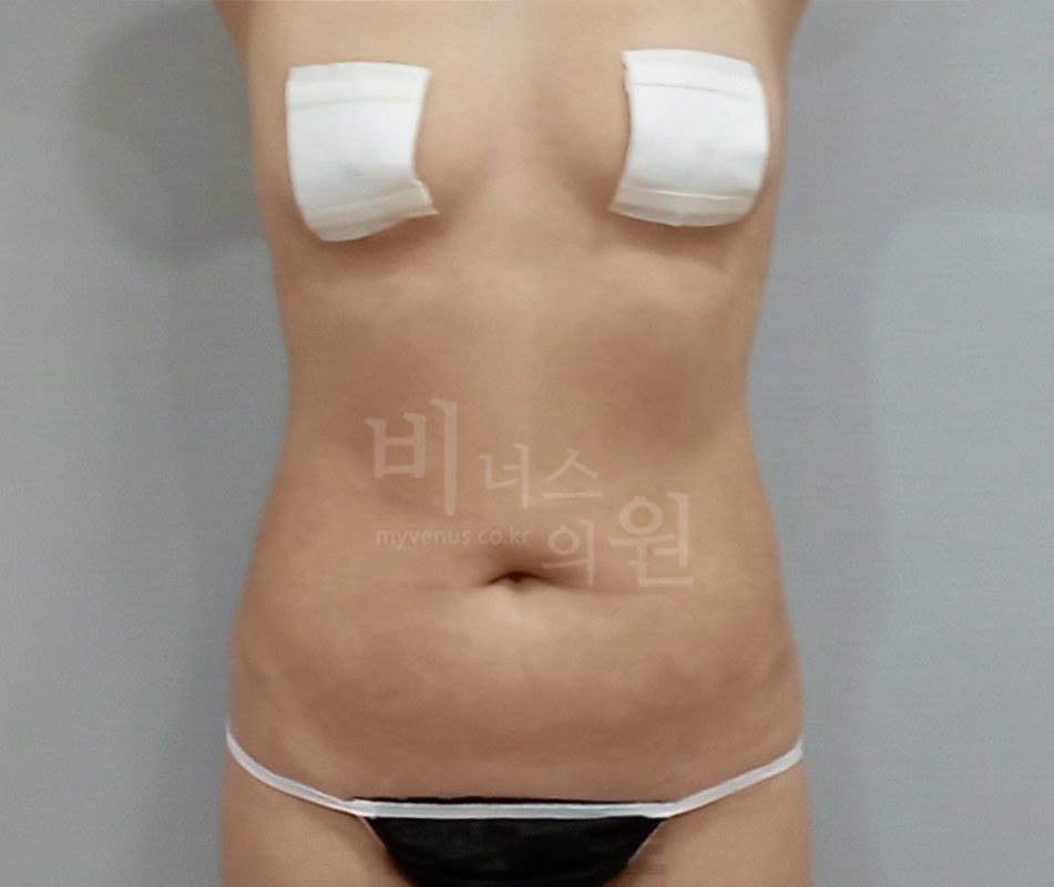 복부 지방흡입 수술 전 정면 비너스의원