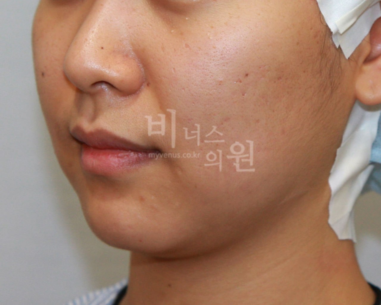 이중턱+턱라인 지방흡입 수술 전 정면 — 부천 비너스의원