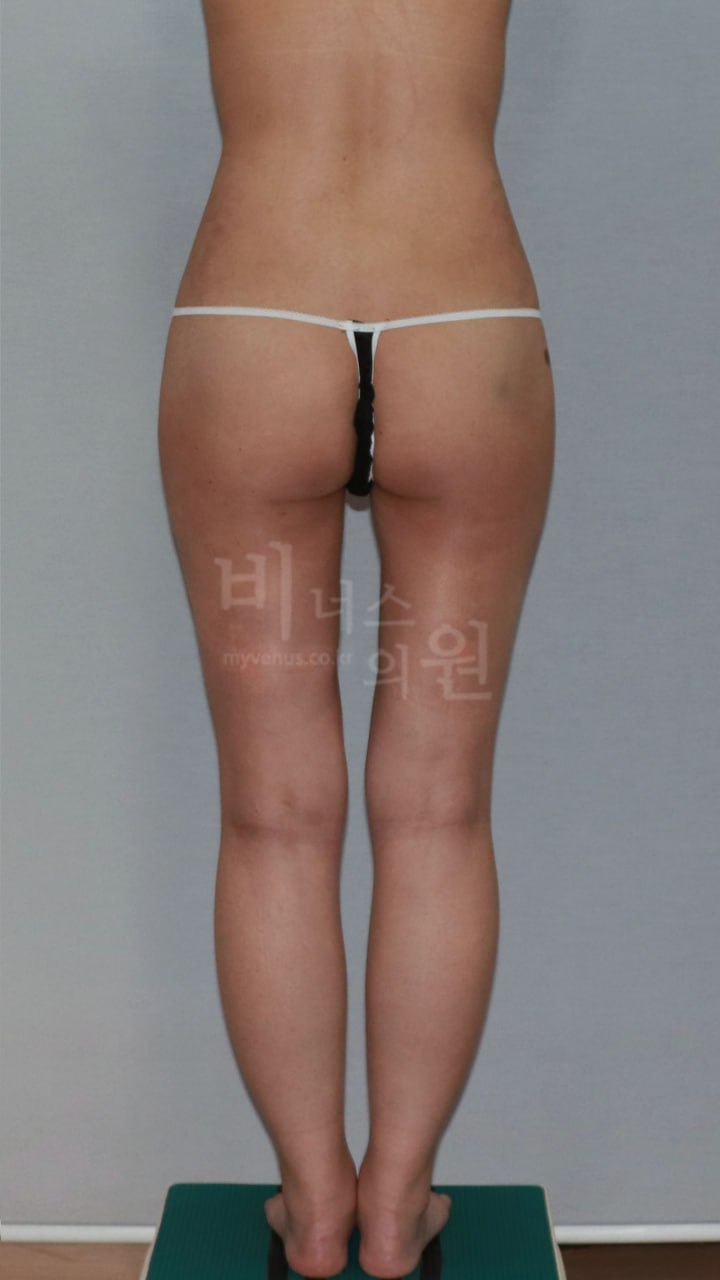 엉덩이지방흡입 수술 후 비너스의원