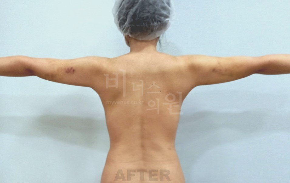 팔뚝 지방흡입 수술 후 비너스의원