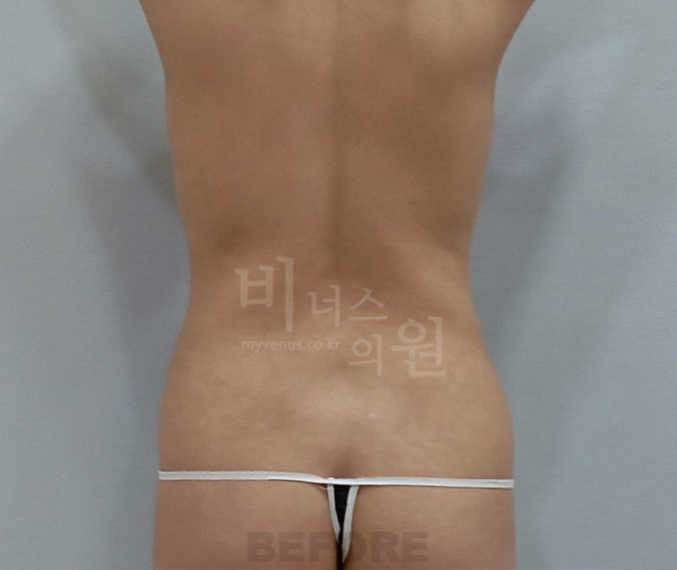 복부 지방흡입 수술 전 후면 비너스의원