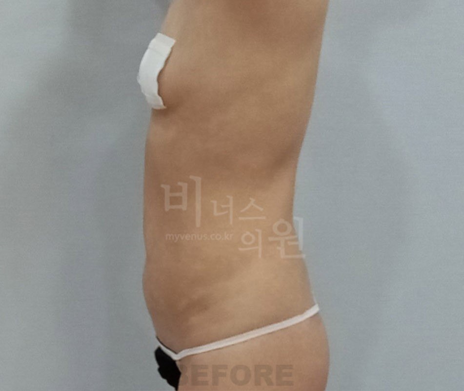 복부 지방흡입 수술 전 측면 비너스의원