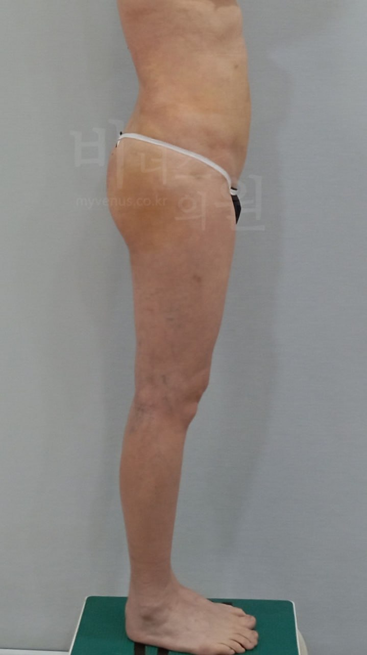 엉덩이 볼륨업 지방흡입 수술 후 우측면