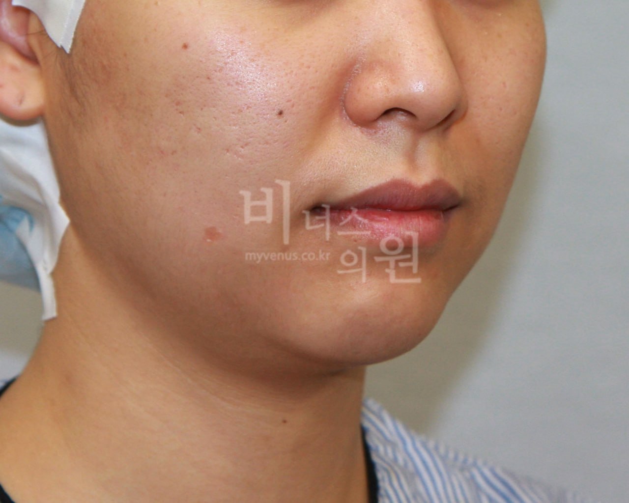 이중턱 지방흡입 수술 전 우측면 목라인 — 부천 비너스의원