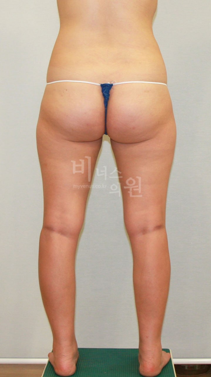 허벅지 지방흡입 수술 전 사례3