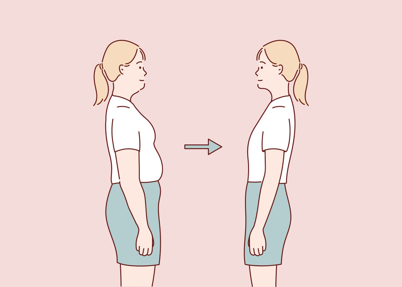 복부 지방흡입 수술 후 회복 및 체형 관리 이미지