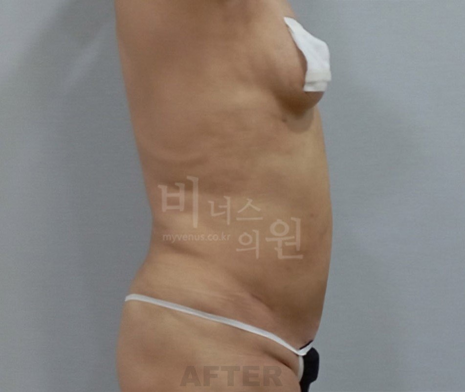 원통형 흉복부 지방흡입 수술 후 측면 (케이스2) 비너스의원