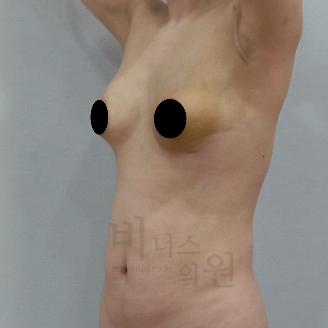 가슴축소 지방흡입 수술 후 45도 측면 비너스의원