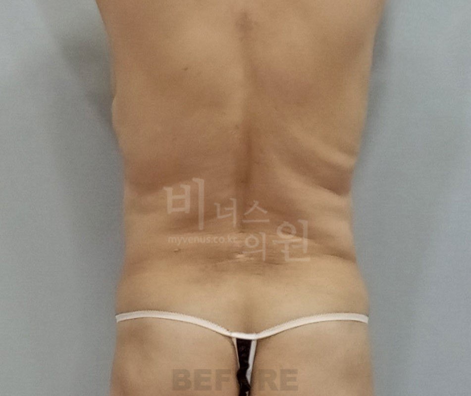 원통형 흉복부 지방흡입 수술 전 후면 비너스의원